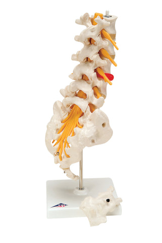 3B Scientific Anatomical Model - lumbar spinal column with dorso-lateral prolapsed disc - Includes 3B Smart Anatomy
