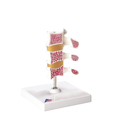 3B Scientific Anatomical Model - Deluxe Osteoporosis Model (3 Vertebrae) - Includes 3B Smart Anatomy