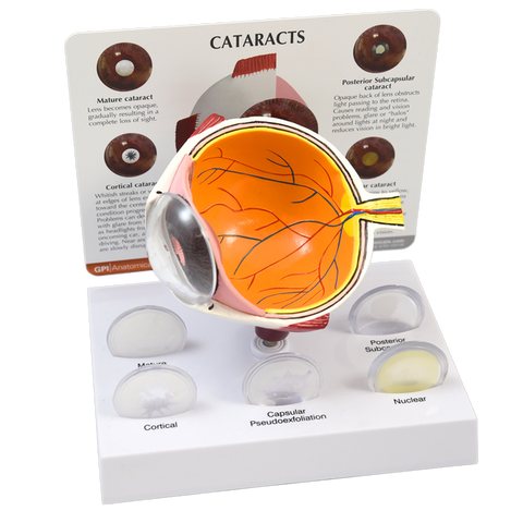 CATARACT EYE MODEL