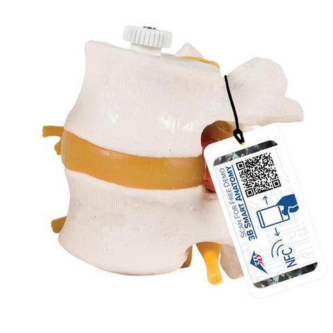 2 Human Lumbar Vertebrae with Prolapsed Disc, Flexibly Mounted - 3B Smart Anatomy