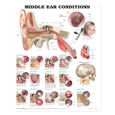 Wolters Kluwer Health Inc Middle Ear Conditions 20x26" Anatomical Chart Ea - 9781605470962