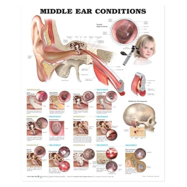 Wolters Kluwer Health Inc Middle Ear Conditions 20x26" Anatomical Chart Ea - 9781605470962