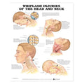 Wolters Kluwer Health Inc Whiplash Injuries Head/Neck 20x26" Educational Chart Ea - 9781587793752