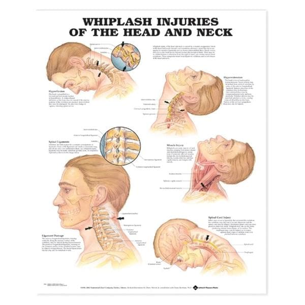 Wolters Kluwer Health Inc Whiplash Injuries Head/Neck 20x26" Educational Chart Ea - 9781587793752