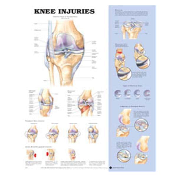 Wolters Kluwer Health Inc Knee Injuries 20x26" Anatomical Chart Ea - 9781587797576