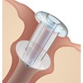 Oasis Medical -Soft Plug Punctal Flow Control Plug 0.6mm 6612-FC
