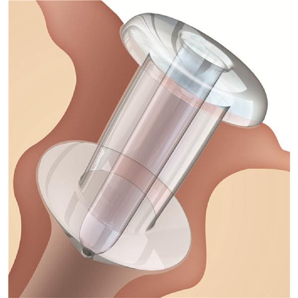 Oasis Medical -Soft Plug Punctal Flow Control Plug 0.7mm 6613-FC