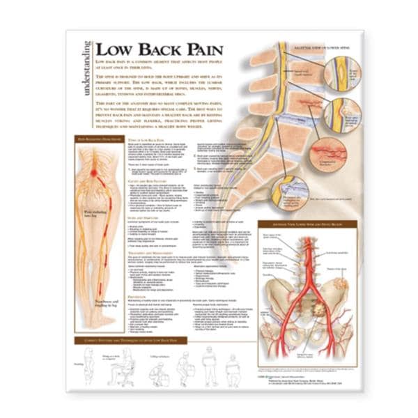 Wolters Kluwer Health Inc Understanding Lower Back Pain 20x26" Anatomical Chart Ea - 9780781782432