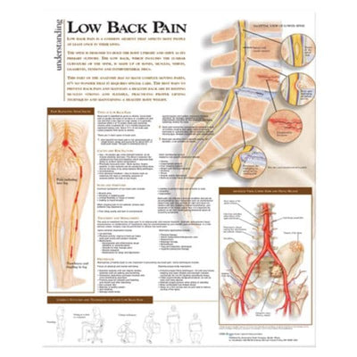 Wolters Kluwer Health Inc Understanding Low Back Pain 20x26" Anatomical Chart Ea - 9780781782425