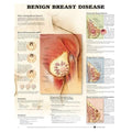 Wolters Kluwer Health Inc Benign Breast Disease 20x26" Anatomical Chart Ea - 9781587796746