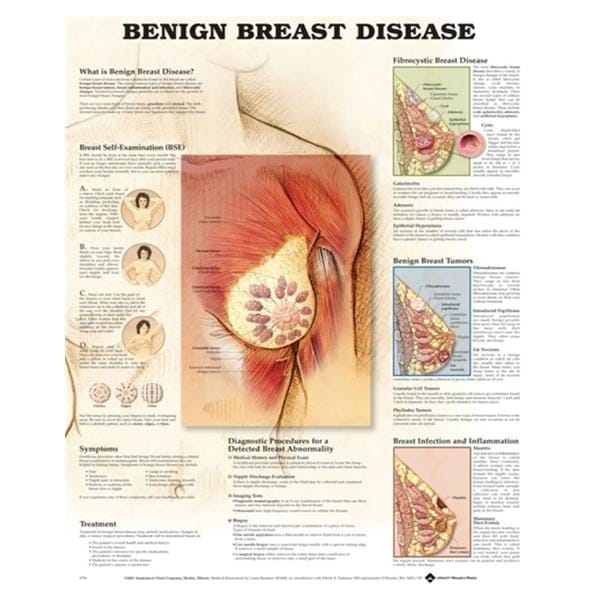 Wolters Kluwer Health Inc Benign Breast Disease 20x26" Anatomical Chart Ea - 9781587796746