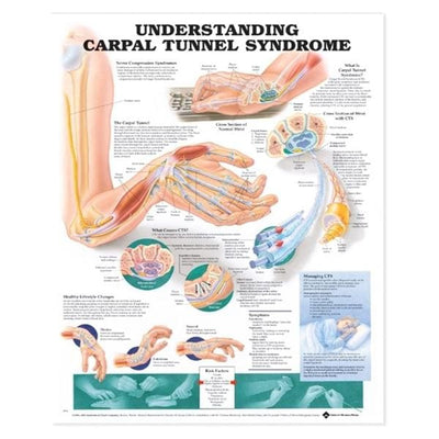 Wolters Kluwer Health Inc Carpel Tunnel Syndrome 20x26" Anatomical Chart Ea - 9781587793219