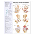 Wolters Kluwer Health Inc Arthritis/Joint 20x26" Anatomical Chart Ea - 9781587793868