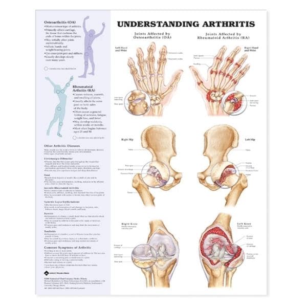 Wolters Kluwer Health Inc Arthritis/Joint 20x26" Anatomical Chart Ea - 9781587793868