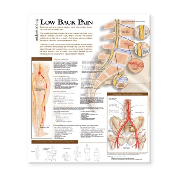 Wolters Kluwer Health Inc Understanding Low Back Pain 20x26" Anatomical Chart Ea - 9780781782432