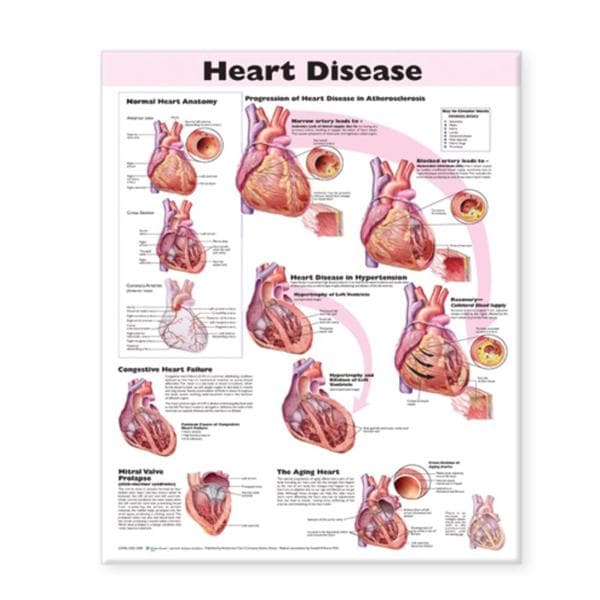 Wolters Kluwer Health Inc Heart Disease 20x26" Educational Poster Ea - 9780781773386