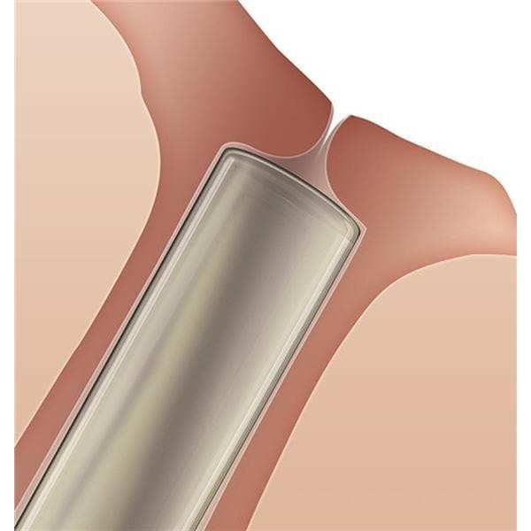 Oasis Medical -Plug Soft Plug Collagen 0.4x2mm 60/Box 6504