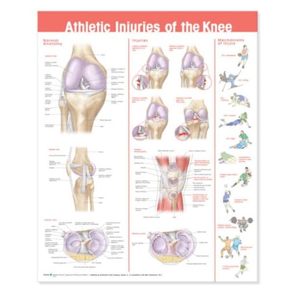 Wolters Kluwer Health Inc Knee Injuries 20x26" Educational Chart Ea - 978078178675