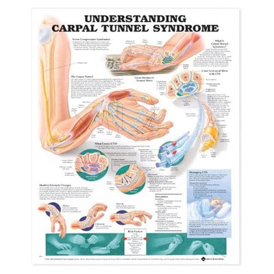 Wolters Kluwer Health Inc Understanding Carpal Tunnel Syndrome 20x26" Educational Chart Ea - 9781587793219