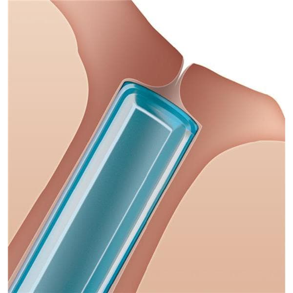 Oasis Medical -Soft Plug Punctum Extended Duration Plug 0.4mm 6404