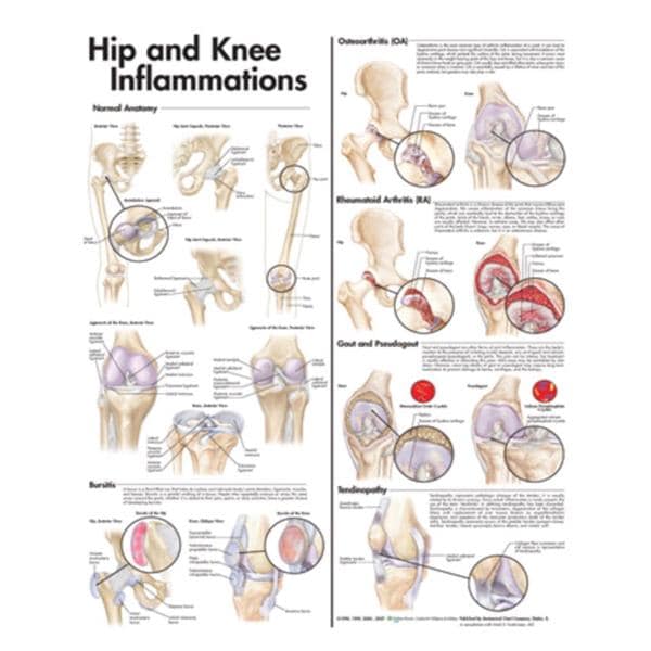 Wolters Kluwer Health Inc Hip and Knee Inflammations 20x26" Anatomical Chart Ea - 9780781773478