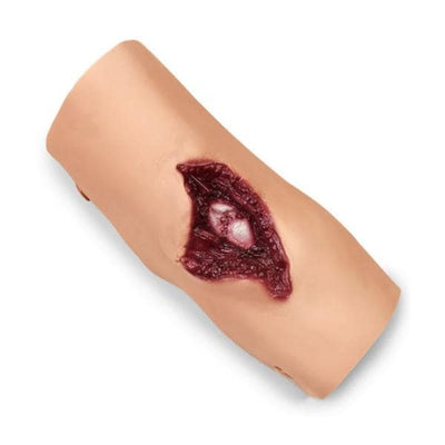 Nasco Healthcare, Inc Moulage Training Compound Fracture Humerus Upper Arm Each - 800-6816