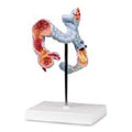 Nasco Healthcare, Inc Colon Diseases Model Anatomical 1/2 Life-Size Each - LA00283