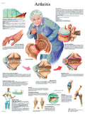 Anatomical Chart - arthritis, laminated 