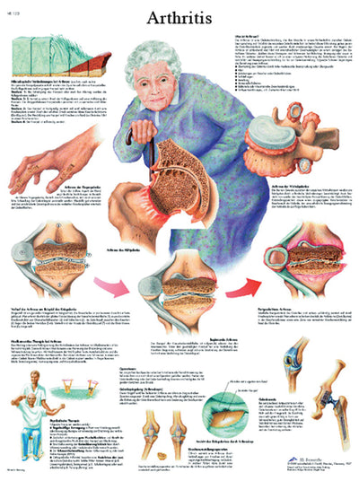 Anatomical Chart - arthritis, laminated 