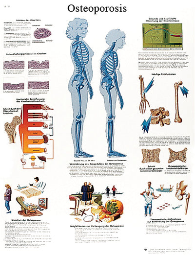 Anatomical Chart - osteoporosis, laminated 