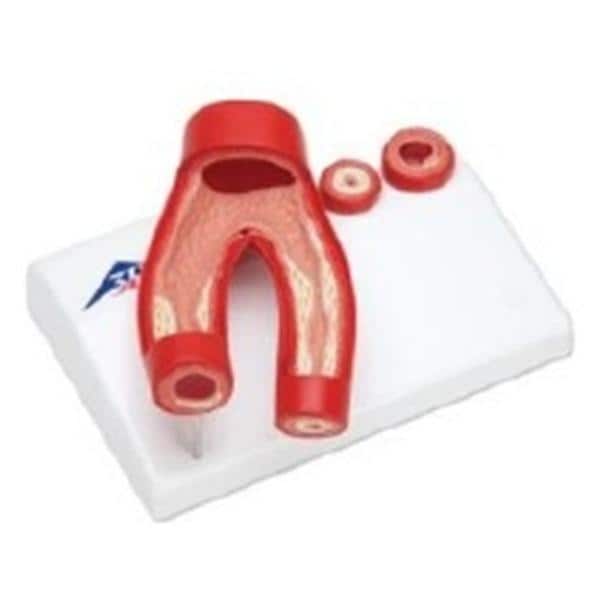 Wards Natural Science Model Arteriosclerosis 3B Scientific Each - 470119-140