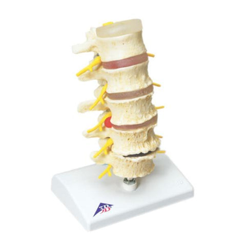Fabrication Enterprises Vertebrae Degeneration Model Anatomical Stages of Prolapsed Disc Each - 15676