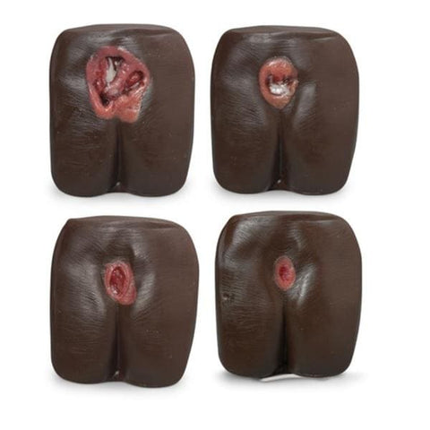 Nasco Healthcare, Inc Bed Sore/Pressure Ulcer Model Anatomical Each - LF00945