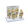 GPI Anatomical Knee Model Anatomical 4-Stage Osteoarthritis 3/4 Scale Each - 70573