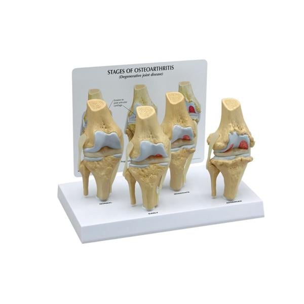 GPI Anatomical Knee Model Anatomical 4-Stage Osteoarthritis 3/4 Scale Each - 70573
