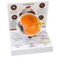CATARACT EYE MODEL