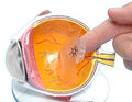 RETINAL DETACHMENT EYE MODEL