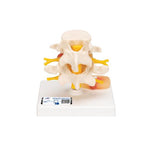 Human Lumbar Spinal Column with Prolapsed Intervertebral Disc - 3B Smart Anatomy