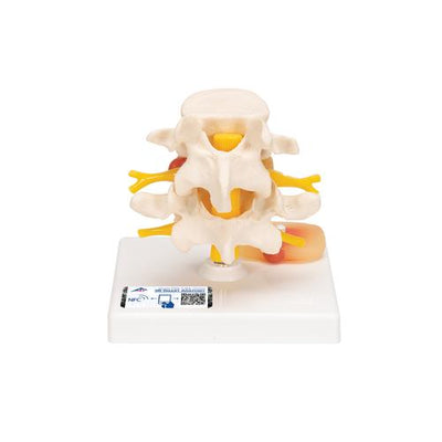 Human Lumbar Spinal Column with Prolapsed Intervertebral Disc - 3B Smart Anatomy