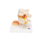 Human Lumbar Spinal Column with Prolapsed Intervertebral Disc - 3B Smart Anatomy