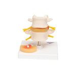 Human Lumbar Spinal Column with Prolapsed Intervertebral Disc - 3B Smart Anatomy