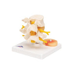 Human Lumbar Spinal Column with Prolapsed Intervertebral Disc - 3B Smart Anatomy