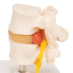 Human Lumbar Spinal Column with Prolapsed Intervertebral Disc - 3B Smart Anatomy