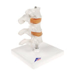 Deluxe Human Osteoporosis Model (3 Vertebrae with Discs ), Removable on Stand - 3B Smart Anatomy