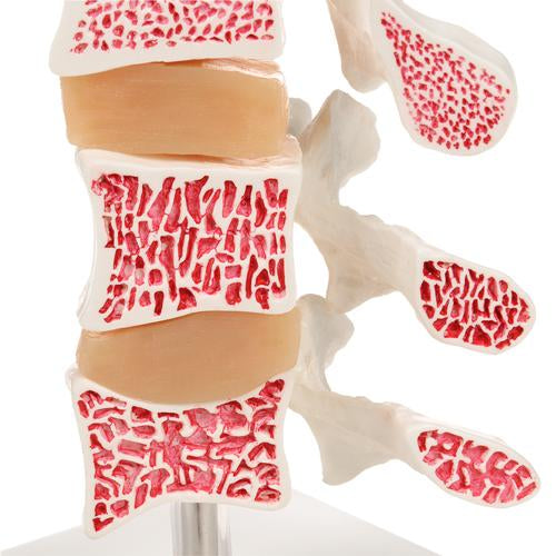 Deluxe Human Osteoporosis Model (3 Vertebrae with Discs ), Removable on Stand - 3B Smart Anatomy