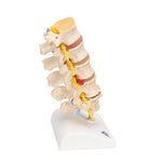 Stages of Disc Prolapse and Vertebral Degeneration - 3B Smart Anatomy