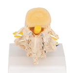 Stages of Disc Prolapse and Vertebral Degeneration - 3B Smart Anatomy