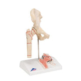 Human Femoral Fracture & Hip Osteoarthritis Model - 3B Smart Anatomy