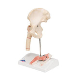 Human Femoral Fracture & Hip Osteoarthritis Model - 3B Smart Anatomy