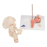 Human Femoral Fracture & Hip Osteoarthritis Model - 3B Smart Anatomy